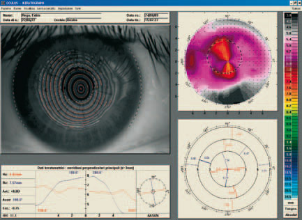 Oculus - Topografia corneale post cheratoplastica